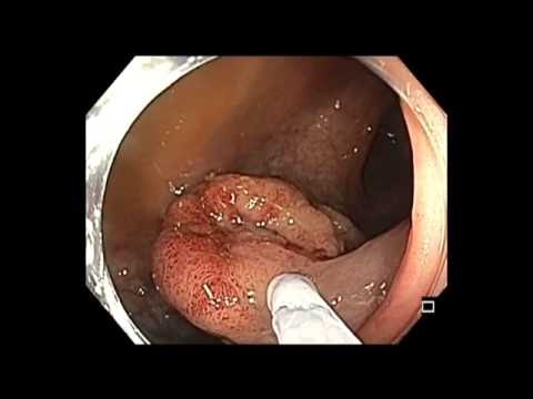 Colonoscopy: Large Rectal Polyp Resection
