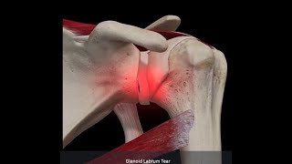 Labral Tears of the Shoulder