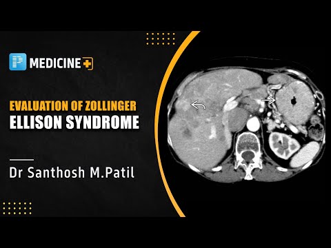 Evaluation of Zollinger Ellison Syndrome by Dr. Santhosh M. Patil | Medicine NEET SS