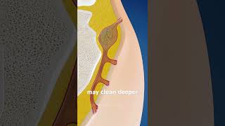 How Surgeons Remove a Painful Pilonidal Sinus (3D Animation) #pilonidalsurgery #pilonidalsinus