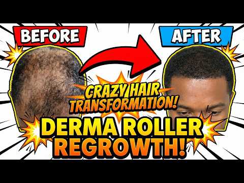 Derma Roller Hair Regrowth - 3 Methods That Worked