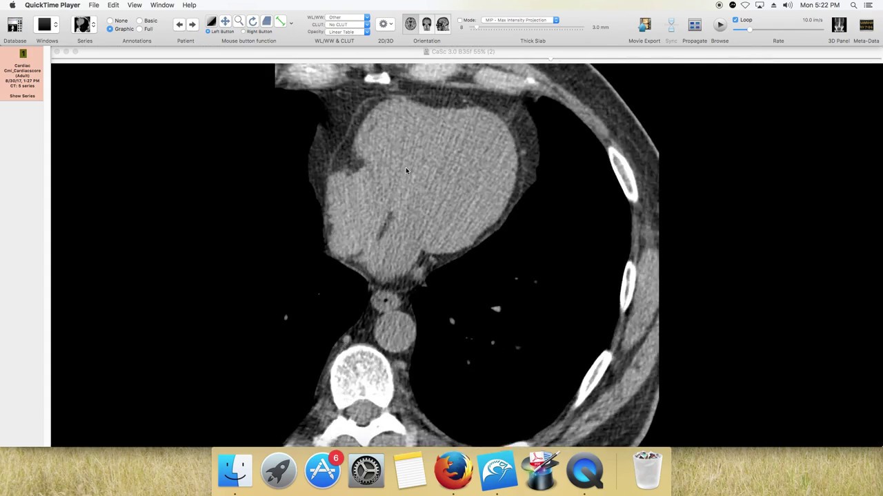 How to Score a Calcium Score Under CT Radiology