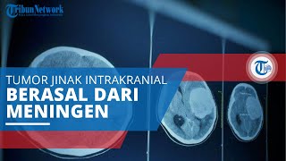 Meningioma, Tumor Jinak Intrakranial Berasal dari Meningen dan Tumbuh di Luar Jaringan Parenkim Otak