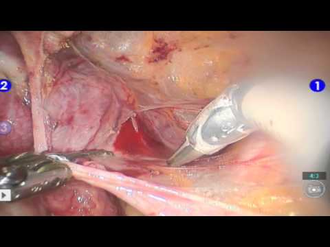 Robotic Surgery for Ovarian Cancer and Endometrial Cancer