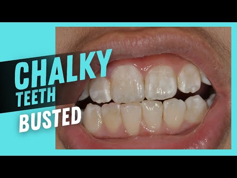 Say Goodbye to Chalky Teeth: Dentist Reveals the Truth.