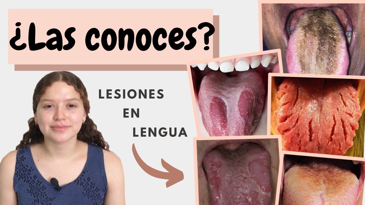 Lesiones en lengua | Lengua fisurada | Lengua vellosa | Glositis migratoria benigna