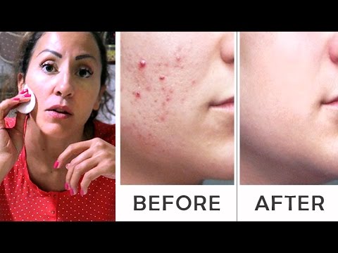 Il klirvin per comprare la crema di decolorazione La maschera per candeggiare di posti di pigmentary