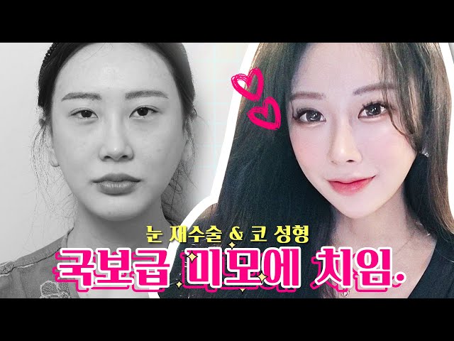 유노성형외과_전후사진/후기_리얼TV 유노성형외과_전후사진/후기_리얼Tv