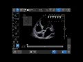Introducing Auto VTI Tool On Venue Family POCUS