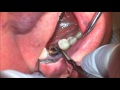 Surgical Extraction of tooth #30 utilizing the Blue Sky Bio Surgy Star Piezo handpiece