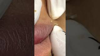 Rows of pimples around the lips #acne #blackheads #acnetreatment #shortvideo #skincare