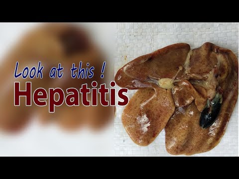 Hepatitis in Broiler Chicken, Clinical Signs, Poultry Farming Video