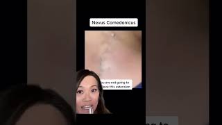 How do you avoid getting these blackheads and whiteheads 👀