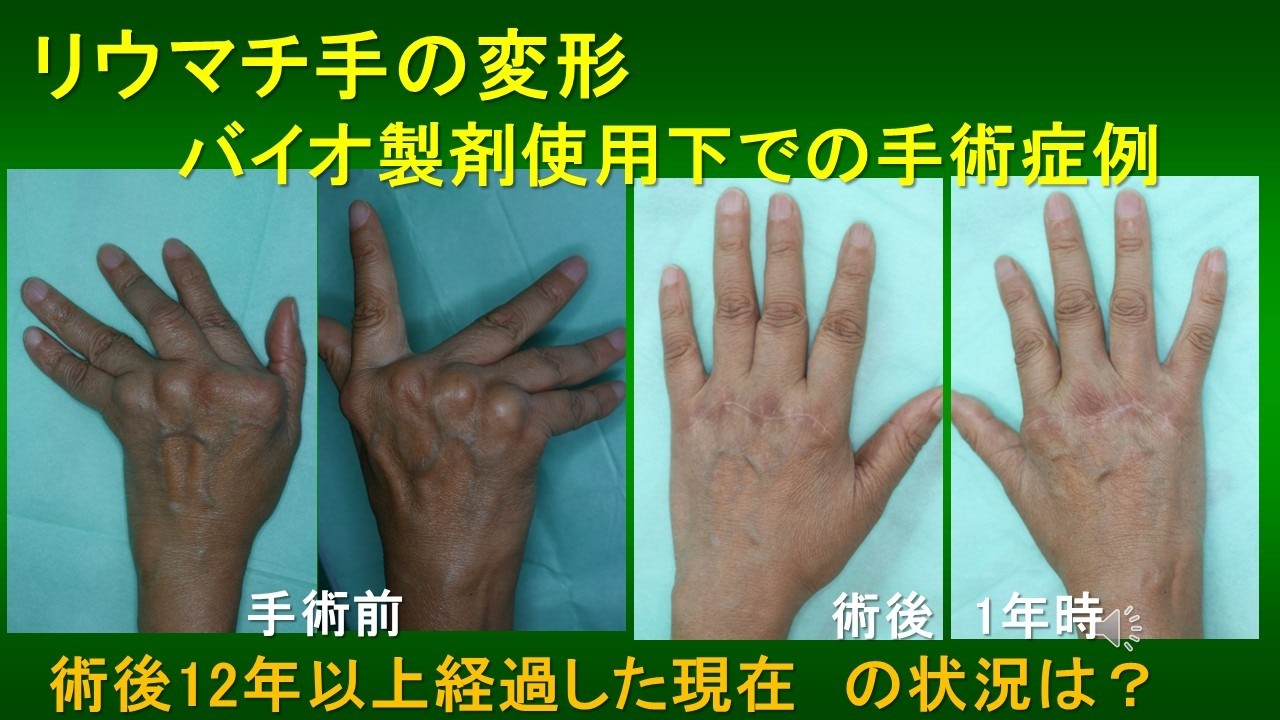 リウマチ手の変形手術（バイオ使用下　術後長期経過例）
