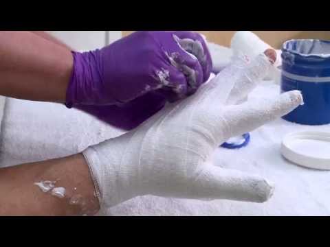 Changing a hand wrapping bandage after a burn injury