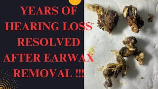 YEARS Of Hearing Loss RESOLVED After This SATISFYING Earwax Removal (MUST WATCH Video)