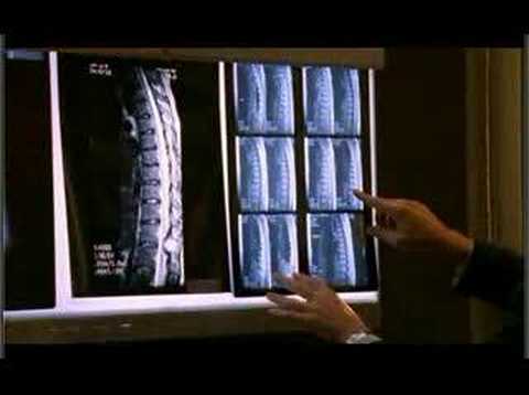 Fibromi e mal di schiena e gambe Le giunzioni tra le vertebre e nervatura