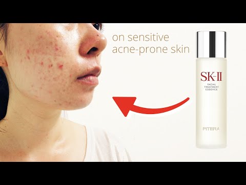 SKII Made Me Breakout 😔 How I Healed My Sensitive, Acne-Prone Skin