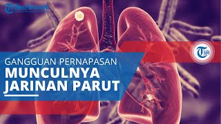 Fibrosis Paru, Gangguan Pernapasan yang Ditandai dengan Munculnya Jaringan Parut di Paru-paru