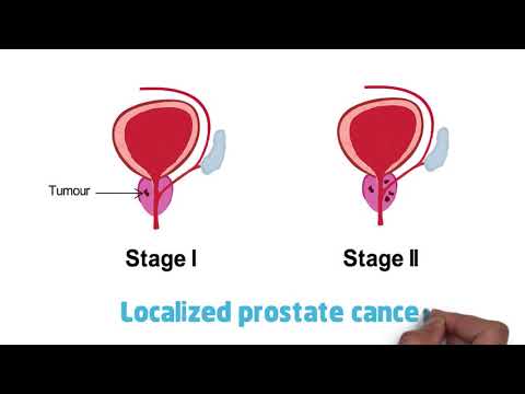 Understanding Prostate Cancer