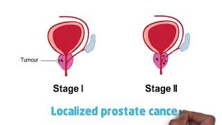 Understanding Prostate Cancer