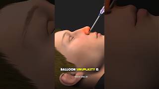 Balloon Sinuplasty Explained in 3D Animation 🧠 | Instant Sinus Relief Procedure #balloonsinuplasty