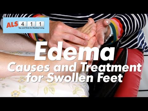 5 Ways to Get Rid of Edema