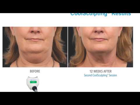 World's #1 Non Invasive Fat Freezing Technology Is Now at Silkor! Before and After Pictures
