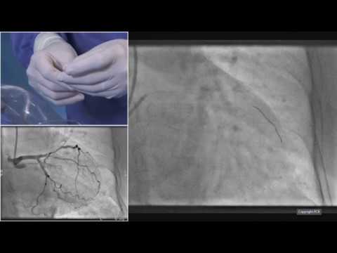 Left main and complex bifurcations stenting - EuroPCR 2019