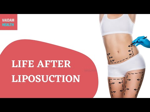 Life after Liposuction
