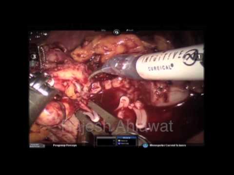 Robotic Partial nephrectomy for a centrally located parahilar tumor