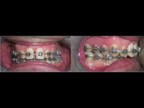 Quanto tempo il mal di schiena dopo anestesia spinale Esterno epicondiliti gomito