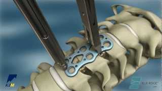 K2M BlueRidge by Zilnav Media