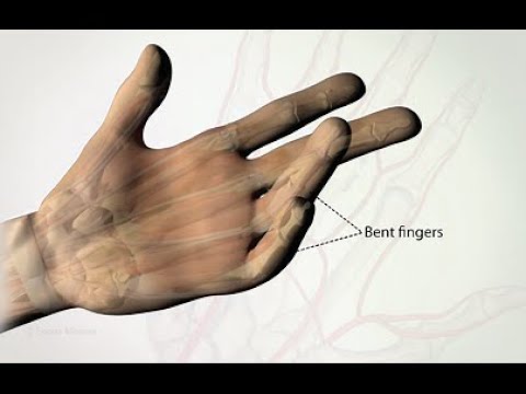 Dupuytrens contracture