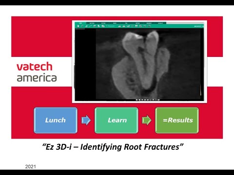 Identifying Root Fractures