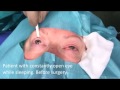 Eye open while sleeping. Surgical treatment - Dr. Aral. LIDMED.com