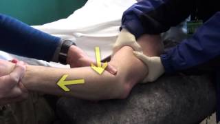 Elbow Dislocation Reduction