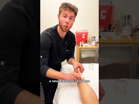 Treating Plantar Fasciitis with Acupuncture