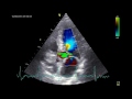 Some Pictures Of A Very Rare Form Of LVOT Obstruction