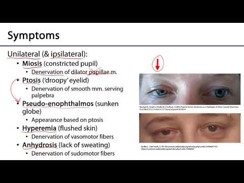 Larynx and Pharynx LO - Horner's Syndrome