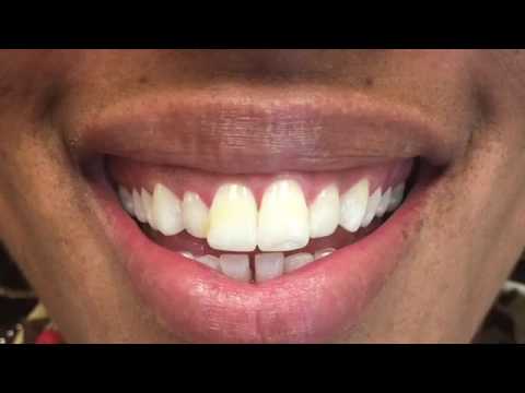 download lagu mp3 mp4 Front Teeth Too Big, download lagu Front Teeth Too Big gratis, unduh video klip Front Teeth Too Big
