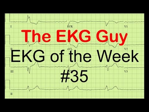 EKG/ECG of the Week #35 | The EKG Guy - www.ekg.md