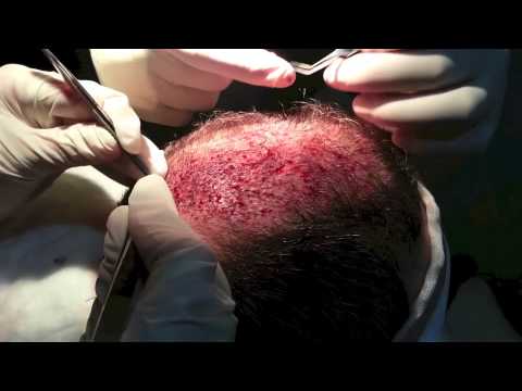 Tasplante de Cabello