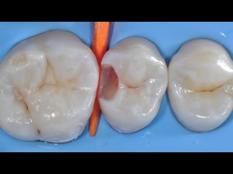 Usunięcie zębiny próchnicowej i preparacja ubytku klasy II