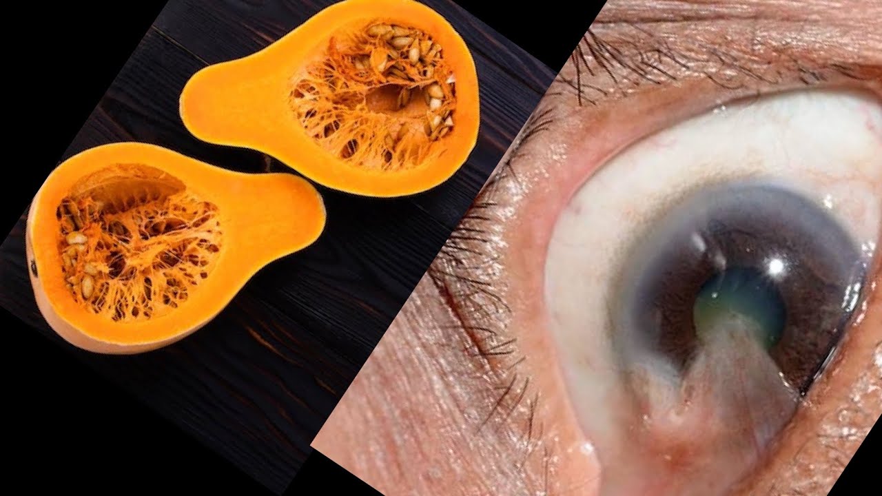 Troquei meus óculos por isso, meu oculista ficou louco quando viu meus examess