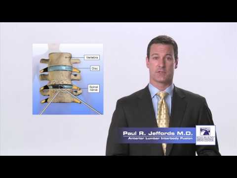 Anterior Lumbar Interbody Fusion - Paul R. Jeffords, M.D.