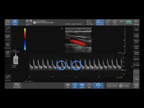 Venue Family Tutorials: Pulse Wave Doppler Optimization