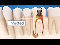 Root Canal Treatment Step by Step