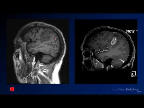 Neuroradiology board review 3 case 10