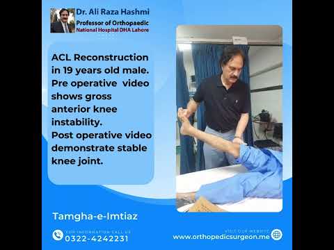 ACL Reconstruction in 19 years old male. Pre operative video shows gross  anterior knee instability.
